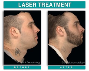 Tattoo Removal, Laser | Chicago| PicoSure | Derick Dermatology