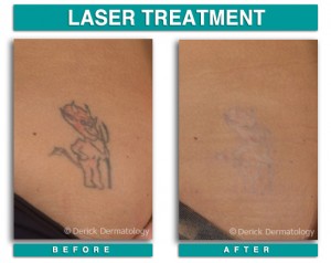 Tattoo Removal, Laser | Chicago| PicoSure | Derick Dermatology