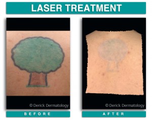 Tattoo Removal, Laser | Chicago| PicoSure | Derick Dermatology