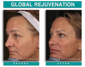 globalrejuv4-300x238