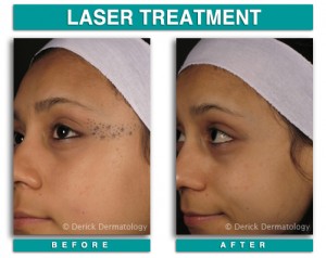 Tattoo Removal, Laser | Chicago| PicoSure | Derick Dermatology