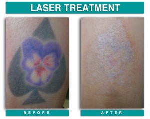 Tattoo Removal, Laser | Chicago| PicoSure | Derick Dermatology