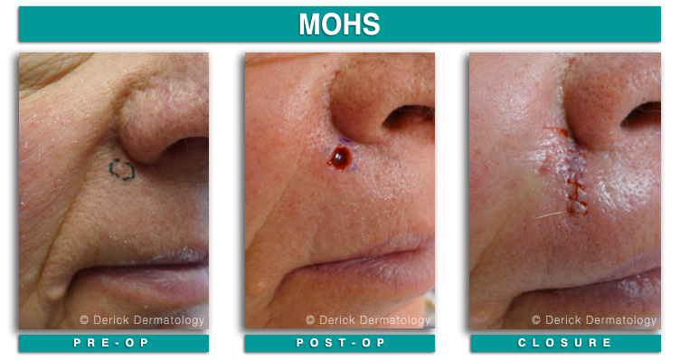 Dermatology Mohs Micrographic Surgery Phototherapy Clinic Contact Us