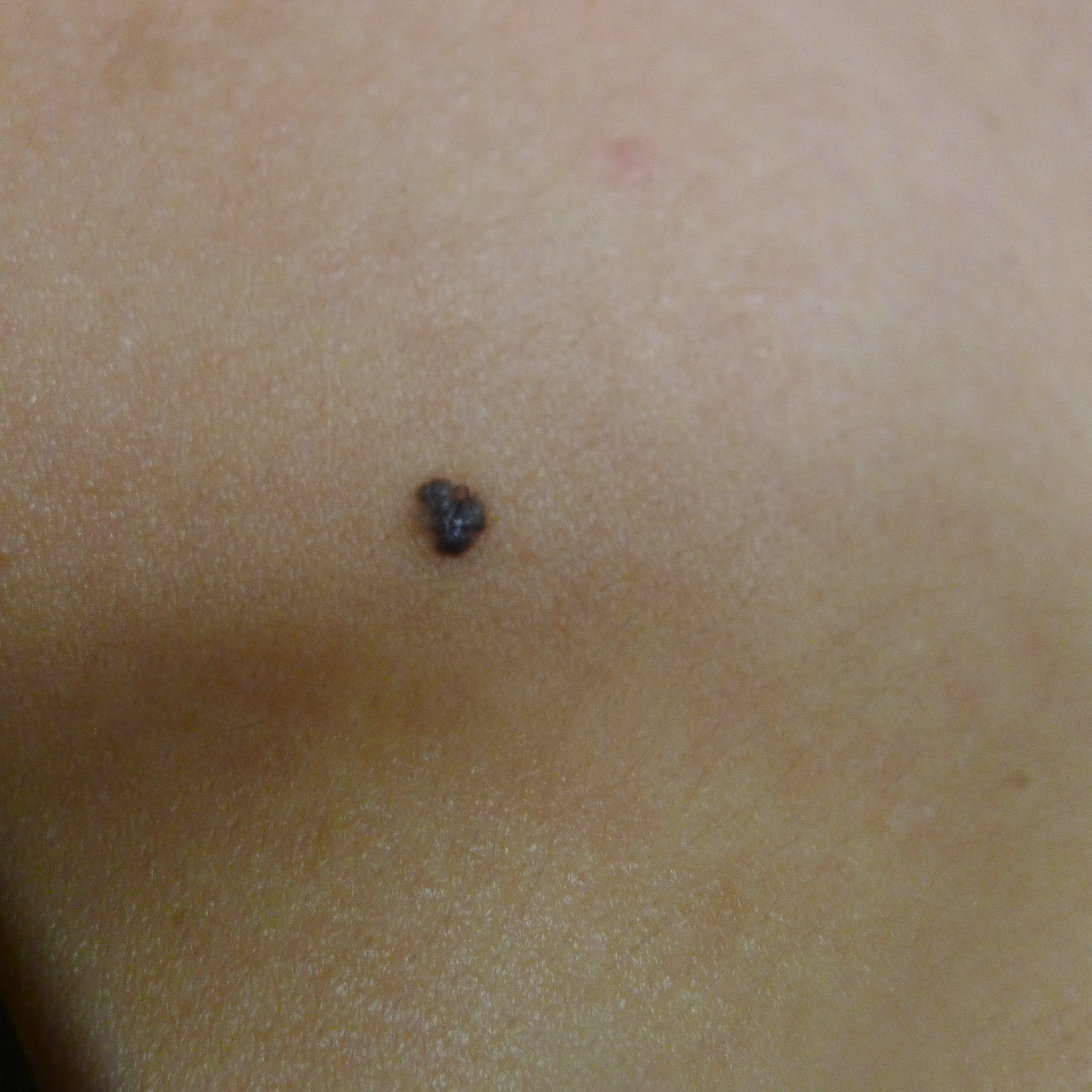 Images Of Skin Cancer On Your Back Cancerwalls