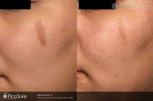 picosure promises faster tattoo removal derick dermatology picosure promises faster tattoo removal derick dermatology